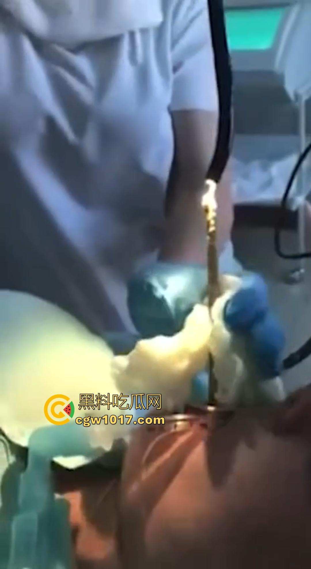 俄罗斯医院活拽1米毒蛇！女患者吞蛇卵孵化钻喉，医生手抖拽出瞬间到处乱窜！  第2张