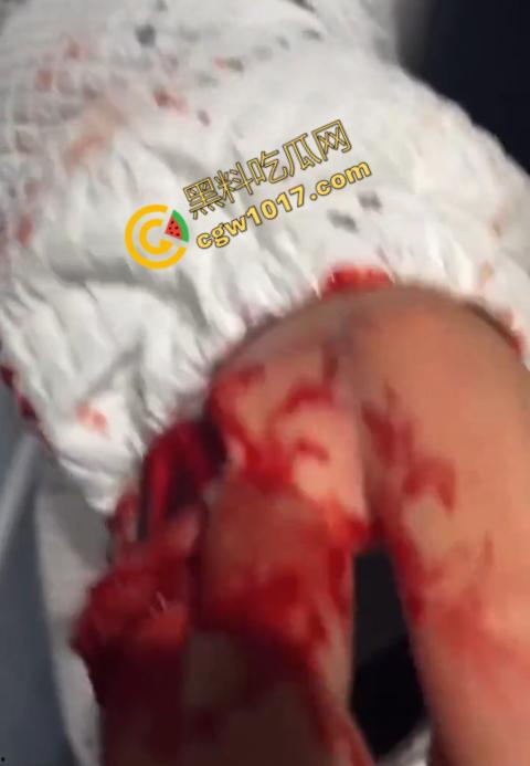 血腥慎点!社会混混残忍虐打小伙,马桶刷戳脸,铁管刺手,手背戳破血肉模糊,骨头暴露,惨不忍睹,令人心寒! 第9张 血腥慎点!社会混混残忍虐打小伙,马桶刷戳脸,铁管刺手,手背戳破血肉模糊,骨头暴露,惨不忍睹,令人心寒! 第9张