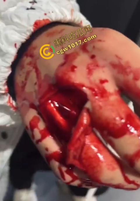 血腥慎点!社会混混残忍虐打小伙,马桶刷戳脸,铁管刺手,手背戳破血肉模糊,骨头暴露,惨不忍睹,令人心寒! 第10张 血腥慎点!社会混混残忍虐打小伙,马桶刷戳脸,铁管刺手,手背戳破血肉模糊,骨头暴露,惨不忍睹,令人心寒! 第10张