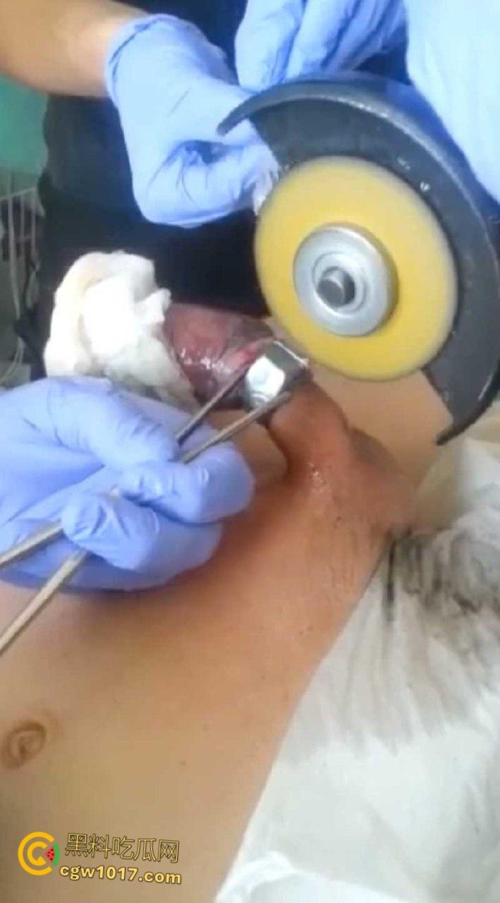 小说照进现实，男子追求刺激螺母自慰，勃起后被螺母卡住，消防人员和医生同时出动，解救被困阴茎 ！  第4张