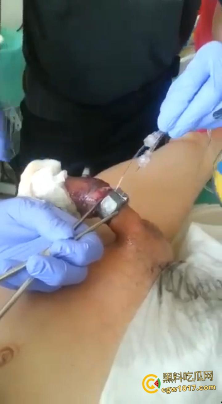 小说照进现实，男子追求刺激螺母自慰，勃起后被螺母卡住，消防人员和医生同时出动，解救被困阴茎 ！  第5张