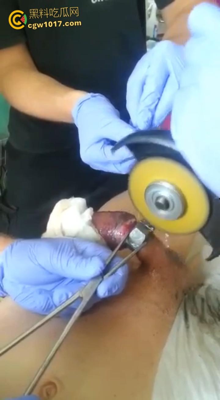 小说照进现实，男子追求刺激螺母自慰，勃起后被螺母卡住，消防人员和医生同时出动，解救被困阴茎 ！  第6张