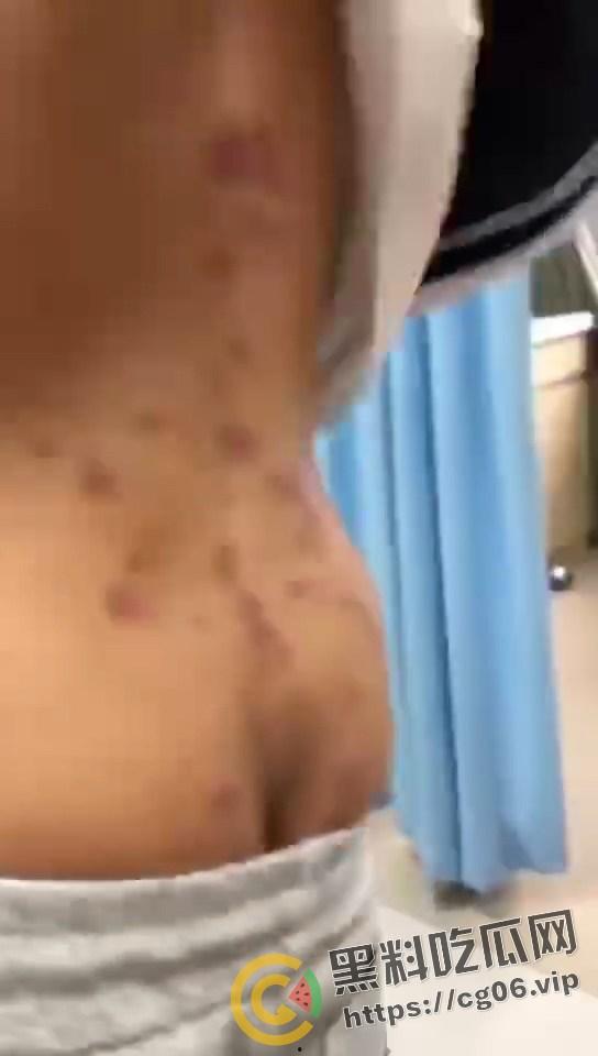 初三学生化身毒王 梅毒三期 艾滋 浑身腐烂 牛子流脓 还说自己没有过性生活 检查现场视频曝光  第2张