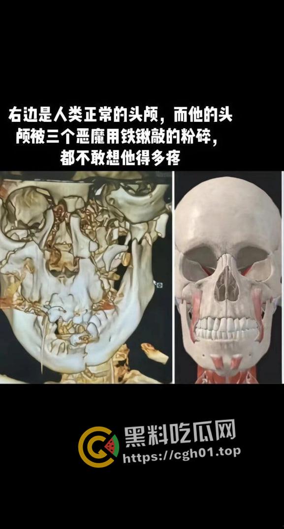 河北邯郸【王子耀】案件后续!相关直播间被封 疑似有家长协助 死者脑部CT流出被打稀烂 疑点重重 第1张 河北邯郸【王子耀】案件后续!相关直播间被封 疑似有家长协助 死者脑部CT流出被打稀烂 疑点重重 第1张